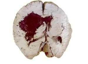 Anisocoria